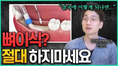 임플란트뼈이식유형, 임플란트 사기 않당하는 방법, 임플란트 뼈이식 지식 정보[바른의사 백승우]